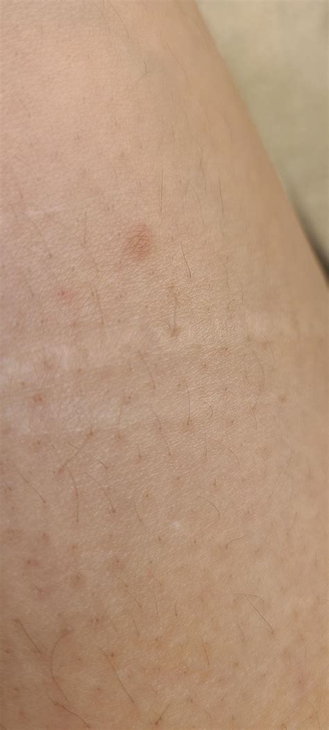 F31 Is This Is A Concern Its On My Right Thigh A Bit Above The Knee