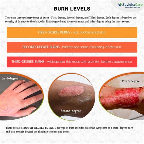 Burn Degrees Chart Understanding The Severity Of Burns Dona