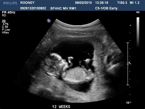 conception 2 bulleteer pregnancy 12 weeks ultrasound pictures