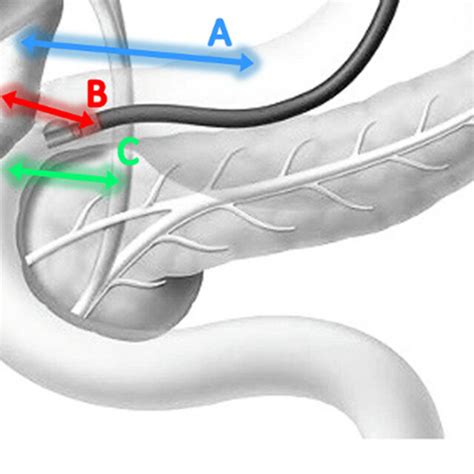 This Figure Describes The Eus Guided Drainage Techniques A