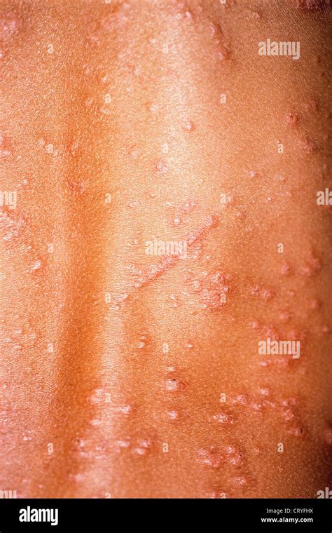 Eczema Stock Photo Alamy