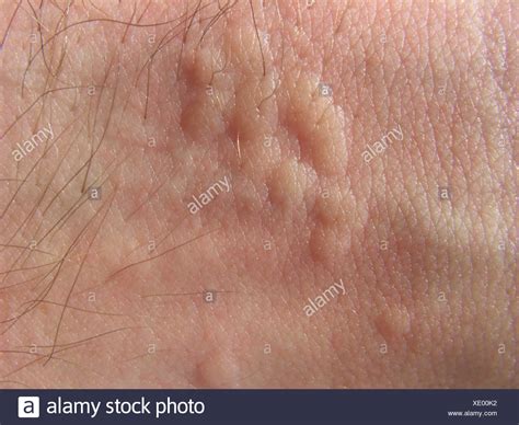 Skin Irritation High Resolution Stock Photography And Images Alamy