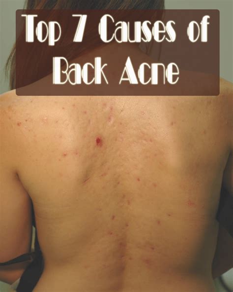 Top 7 Causes Of Back Acne Fit Db
