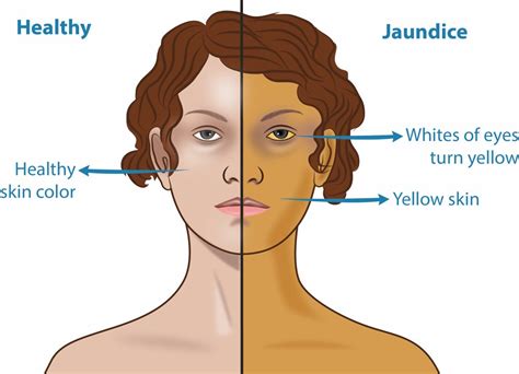 Yellow Skin Jaundice Pictures Symptoms Causes And Diagnosis