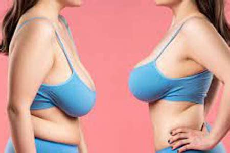 Breast Reduction Surgery Causes Symptoms Diagnosis