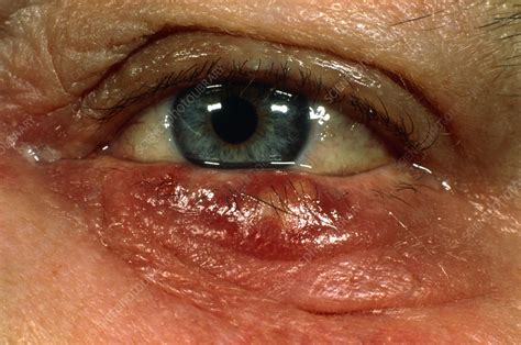 Stye Hordeolum On Patients Lower Eyelid Stock Image M1300478