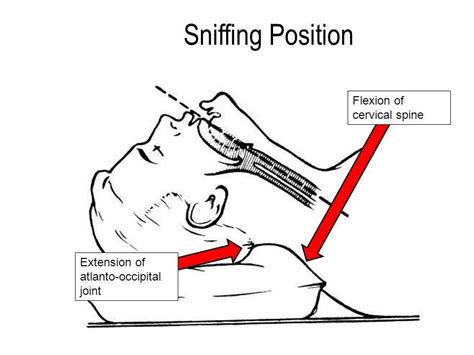 Sniffing Position For Intubation Lma Application Anesthesia