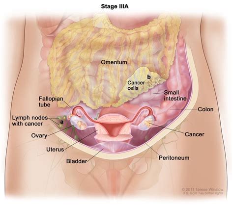 Ovarian Epithelial Fallopian Tube And Primary Peritoneal Cancer