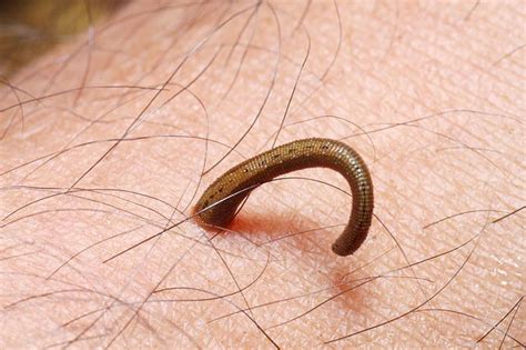 Leech On Human Skin Parasites Symptoms Heath Tips Skin Parasites