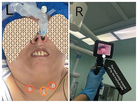 Frontiers Case Report Nasal Polyp Exfoliated Into The Tracheal Tube