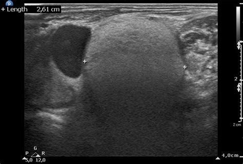 Ultrasound Image Showing Left Supraclavicular Solid Nodule