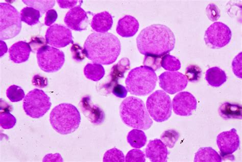 Leukemia Under Microscope Hot Sex Picture