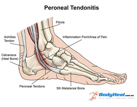 Peroneal Tendinopathy PhysioNow Mississauga Physiotherapy