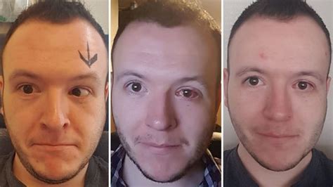 Your eyes won't immediately get better either. This Man's Photos Capture How Lazy Eye Surgery Changed His ...