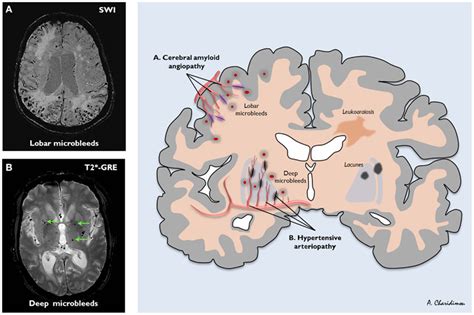 The distribution of sporadic small vessel disease in the brain and the