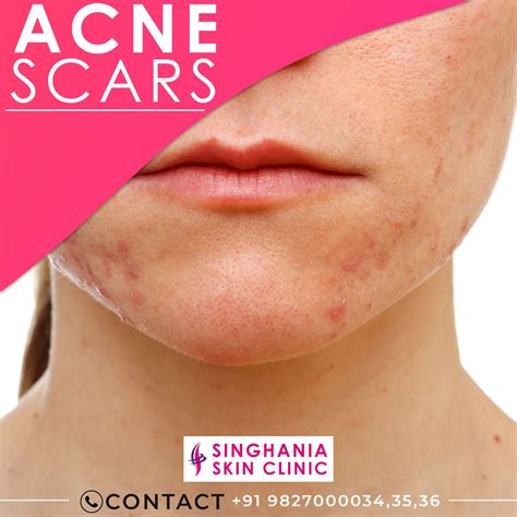 Causes Of Acne Scars Singhania Skin Clinic