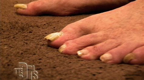 Ugliest Feet Makeover The Doctors Tv Show