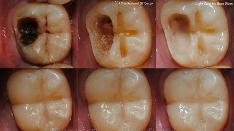 What Is Decay Types Of Dental Decay Dentist Central London