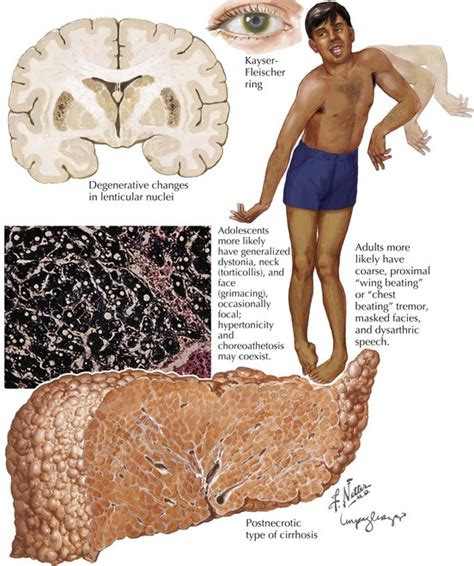 Wilson Disease Neupsy Key