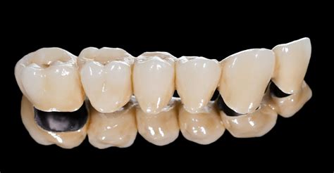 Dental Crowns And Bridges By Blairsville Dentistry Blairsville Ga