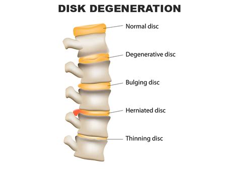 Herniated Disc C4c5 And C5c6 Injuries Fort Worth Tx Stephens Law