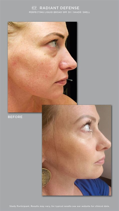 20 Rodan And Fields Before And After Pictures That Will Shock You The