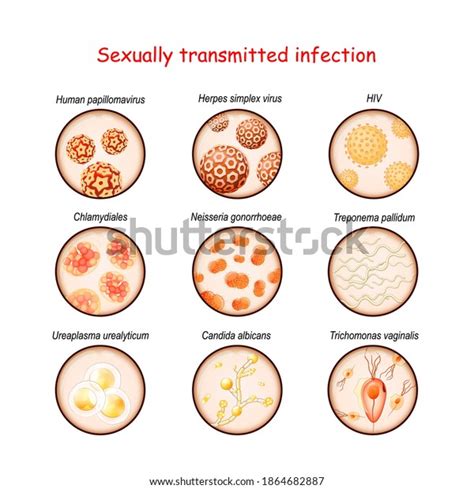 Sexually Transmitted Infection Closeup Causative Agents Stock Vector