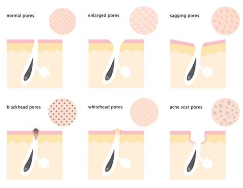 Although There Is Nothing You Can Do To Actually Decrease Pore Size