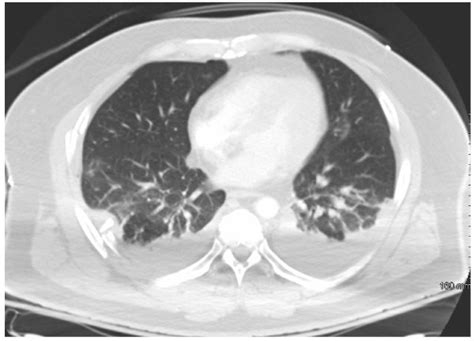 Ct Scan Of The Chest Illustrates Bilateral Pleural Effusions