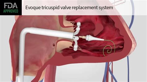 Fda Approves First Transcatheter Tricuspid Valve Replacement Device