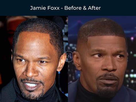 Celebrity Hair Transplant Before And After