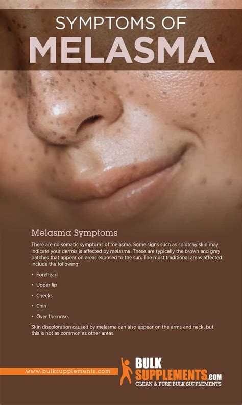 Melasma Symptoms Causes Treatment