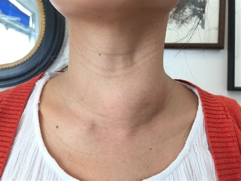 Thyroid Radiofrequency Ablation Rfa Of Thyroid Nodules Thyroid