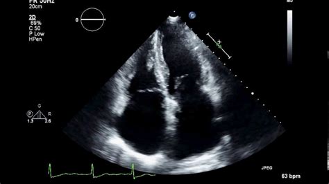 Practice Visual Estimation Of Left Ventricular Ejection Fraction Atrial