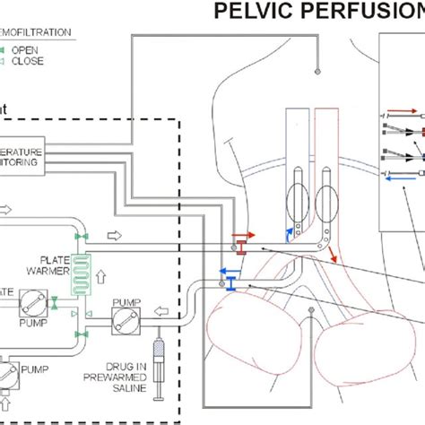 Schematic Representation Of Hypoxic Pelvic Perfusion Hpp With