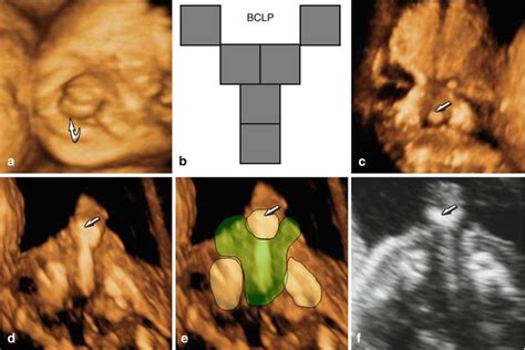 The Role Of 2d3d4d Ultrasound In The Prenatal Assessment Of Cleft Lip