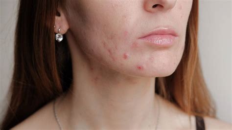 What Are Blemishes Identifying Spots On Your Face Loréal Paris