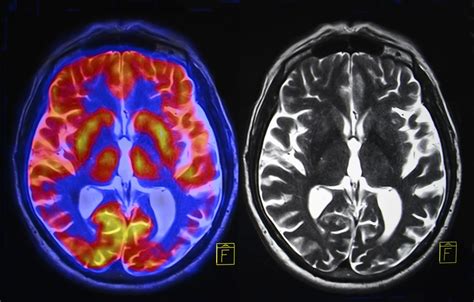 Is Hiv Hiding In Your Brain Mri Scans Can Identify Virus From Changes