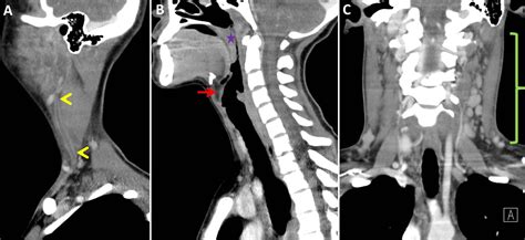 Peritonsillar And Neck Cellulitis Lemierre Syndrome Image