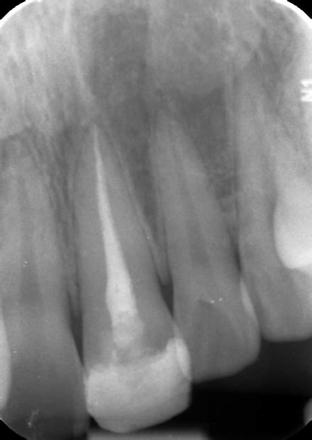 Root Canal After Dental On Flinders