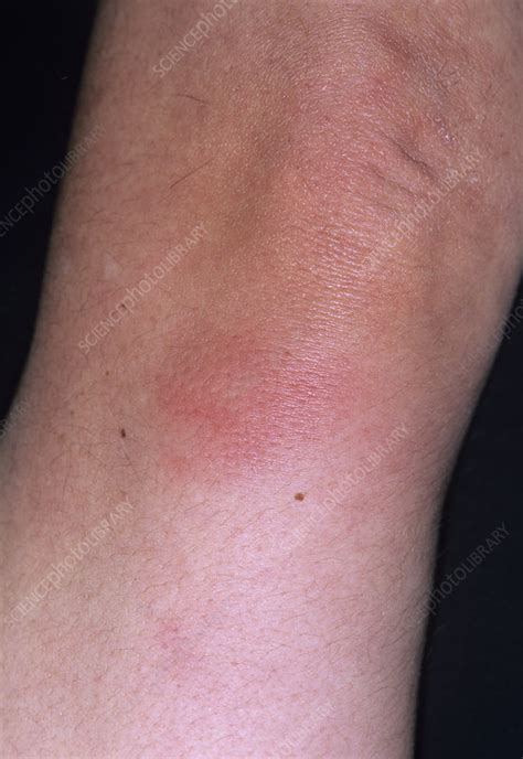 Swollen Arm Stock Image M1500246 Science Photo Library