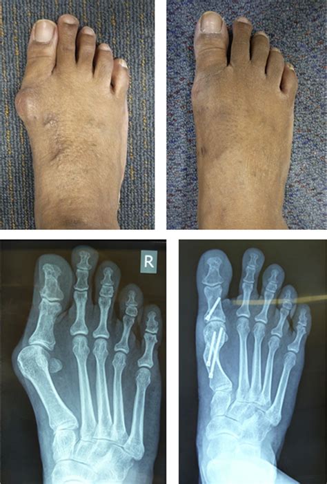 Percutaneous Surgery For Mild To Moderate Hallux Valgus Foot And