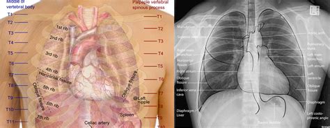 Basics Of Reading Chest Xray Complete Guide To Cxr Be