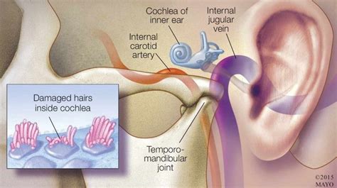 Tinnitus Relief How Tmj Dysfunction Can Cause Tinnitus And Tmj Ear Pain