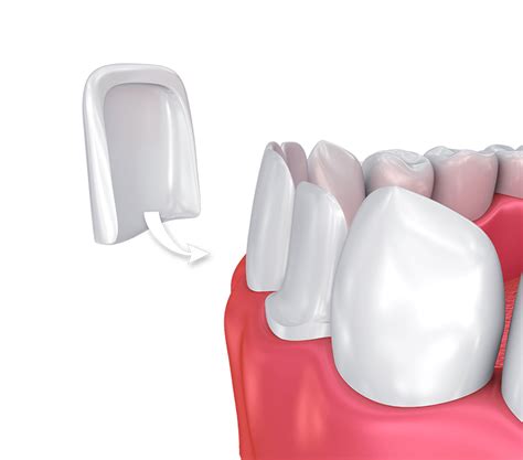 Dental Crowns And Dental Bridges Sonoma Dental Group Dentist In