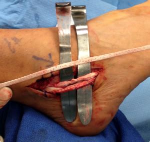 In the young, muscle usually tears before the attached tendon does. Me and my calcaneal osteotomy and tendon restructure ...