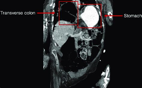 Ct Scan Of The Abdomen And Pelvis Showing A Large Right Sided Bochdalek