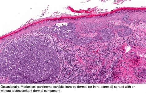 Images images used with permission of journal of the american academy. Pathology Outlines - Merkel cell carcinoma