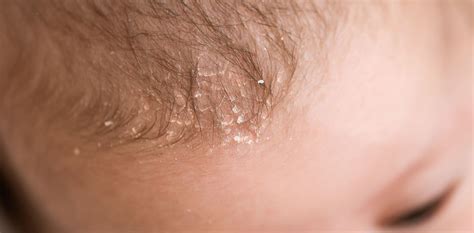 Seborrheic Dermatitis Treatments Mesa Az Sagebrush Dermatology
