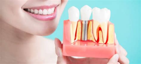 Getting A Perfect Smile With Dental Implants West Cobb Dentistry